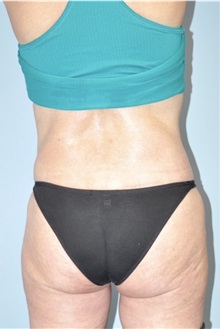 Buttock Lift with Augmentation After Photo by Keyian Paydar, MD, FACS; Newport Beach, CA - Case 51132
