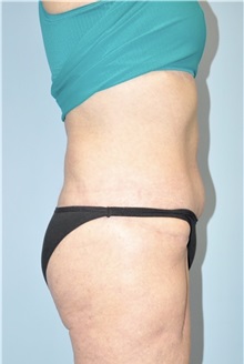 Buttock Lift with Augmentation After Photo by Keyian Paydar, MD, FACS; Newport Beach, CA - Case 51132