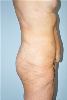 Buttock Lift with Augmentation Before Photo by Keyian Paydar, MD, FACS; Newport Beach, CA - Case 51132