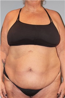 Tummy Tuck Before Photo by Keyian Paydar, MD, FACS; Newport Beach, CA - Case 51134