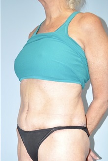 Tummy Tuck After Photo by Keyian Paydar, MD, FACS; Newport Beach, CA - Case 51134