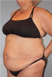 Tummy Tuck Before Photo by Keyian Paydar, MD, FACS; Newport Beach, CA - Case 51134