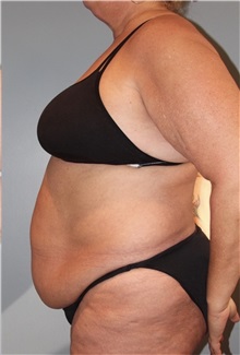 Tummy Tuck Before Photo by Keyian Paydar, MD, FACS; Newport Beach, CA - Case 51134
