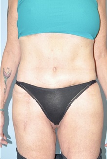 Body Lift After Photo by Keyian Paydar, MD, FACS; Newport Beach, CA - Case 51131