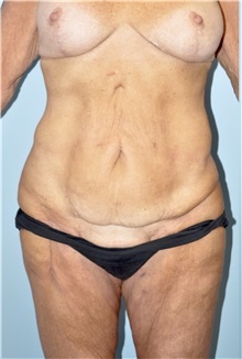 Body Lift Before Photo by Keyian Paydar, MD, FACS; Newport Beach, CA - Case 51131