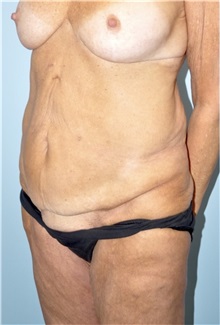 Body Lift Before Photo by Keyian Paydar, MD, FACS; Newport Beach, CA - Case 51131