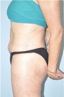 Body Lift After Photo by Keyian Paydar, MD, FACS; Newport Beach, CA - Case 51131