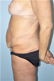Body Lift Before Photo by Keyian Paydar, MD, FACS; Newport Beach, CA - Case 51131
