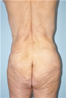 Body Lift Before Photo by Keyian Paydar, MD, FACS; Newport Beach, CA - Case 51131