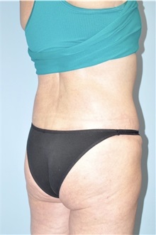 Body Lift After Photo by Keyian Paydar, MD, FACS; Newport Beach, CA - Case 51131