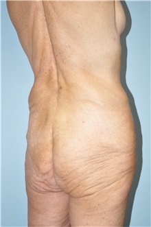 Body Lift Before Photo by Keyian Paydar, MD, FACS; Newport Beach, CA - Case 51131