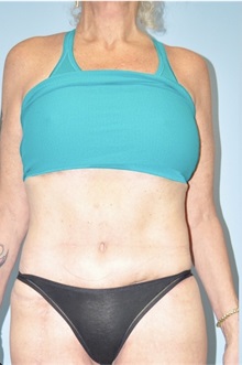 Liposuction After Photo by Keyian Paydar, MD, FACS; Newport Beach, CA - Case 51135