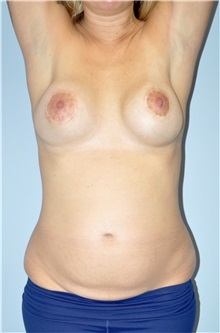 Mommy Makeover Before Photo by Keyian Paydar, MD, FACS; Newport Beach, CA - Case 51147