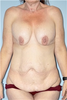 Tummy Tuck Before Photo by Keyian Paydar, MD, FACS; Newport Beach, CA - Case 51148