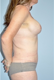 Tummy Tuck After Photo by Keyian Paydar, MD, FACS; Newport Beach, CA - Case 51148