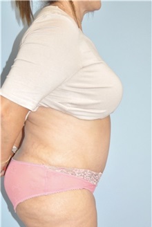 Liposuction After Photo by Keyian Paydar, MD, FACS; Newport Beach, CA - Case 51165