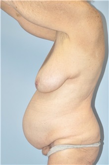 Mommy Makeover Before Photo by Keyian Paydar, MD, FACS; Newport Beach, CA - Case 51185