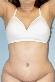 Tummy Tuck After Photo by Keyian Paydar, MD, FACS; Newport Beach, CA - Case 51180
