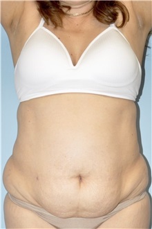 Tummy Tuck Before Photo by Keyian Paydar, MD, FACS; Newport Beach, CA - Case 51180
