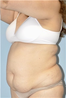 Tummy Tuck Before Photo by Keyian Paydar, MD, FACS; Newport Beach, CA - Case 51180