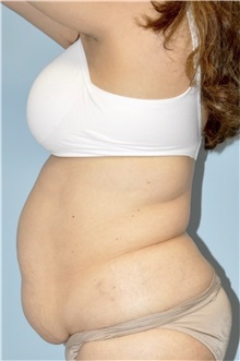 Tummy Tuck Before Photo by Keyian Paydar, MD, FACS; Newport Beach, CA - Case 51180