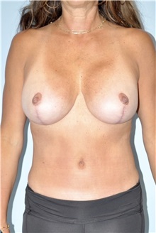 Tummy Tuck After Photo by Keyian Paydar, MD, FACS; Newport Beach, CA - Case 51181