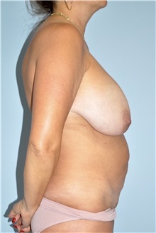 Mommy Makeover Before Photo by Keyian Paydar, MD, FACS; Newport Beach, CA - Case 51182