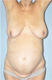 Tummy Tuck Before Photo by Keyian Paydar, MD, FACS; Newport Beach, CA - Case 51183