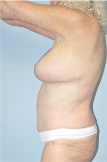 Tummy Tuck After Photo by Keyian Paydar, MD, FACS; Newport Beach, CA - Case 51183