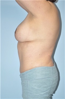 Mommy Makeover After Photo by Keyian Paydar, MD, FACS; Newport Beach, CA - Case 51198
