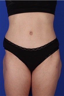 Tummy Tuck After Photo by Keyian Paydar, MD, FACS; Newport Beach, CA - Case 51189