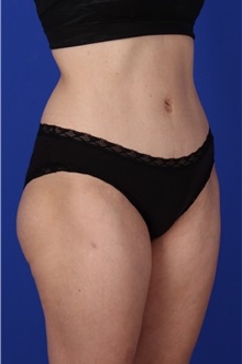 Tummy Tuck After Photo by Keyian Paydar, MD, FACS; Newport Beach, CA - Case 51189