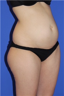 Tummy Tuck Before Photo by Keyian Paydar, MD, FACS; Newport Beach, CA - Case 51189