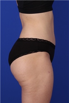Tummy Tuck After Photo by Keyian Paydar, MD, FACS; Newport Beach, CA - Case 51189
