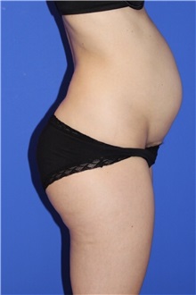 Tummy Tuck Before Photo by Keyian Paydar, MD, FACS; Newport Beach, CA - Case 51189