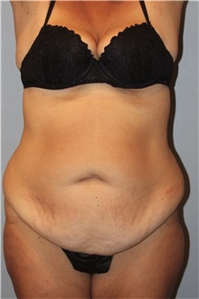 Liposuction Before Photo by Keyian Paydar, MD, FACS; Newport Beach, CA - Case 51192