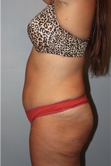 Liposuction After Photo by Keyian Paydar, MD, FACS; Newport Beach, CA - Case 51192