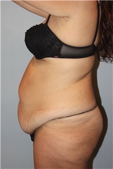 Liposuction Before Photo by Keyian Paydar, MD, FACS; Newport Beach, CA - Case 51192