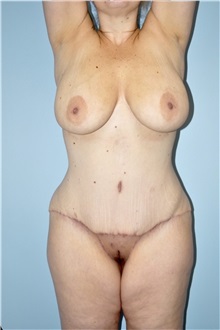 Tummy Tuck After Photo by Keyian Paydar, MD, FACS; Newport Beach, CA - Case 51196