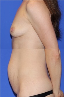 Mommy Makeover Before Photo by Keyian Paydar, MD, FACS; Newport Beach, CA - Case 51193