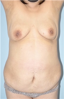Tummy Tuck Before Photo by Keyian Paydar, MD, FACS; Newport Beach, CA - Case 51197