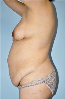 Tummy Tuck Before Photo by Keyian Paydar, MD, FACS; Newport Beach, CA - Case 51197