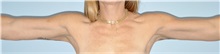 Arm Lift After Photo by Keyian Paydar, MD, FACS; Newport Beach, CA - Case 51203