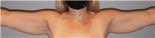Arm Lift Before Photo by Keyian Paydar, MD, FACS; Newport Beach, CA - Case 51203