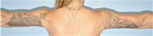 Arm Lift After Photo by Keyian Paydar, MD, FACS; Newport Beach, CA - Case 51203