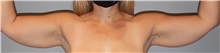 Arm Lift Before Photo by Keyian Paydar, MD, FACS; Newport Beach, CA - Case 51203