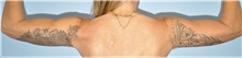 Arm Lift After Photo by Keyian Paydar, MD, FACS; Newport Beach, CA - Case 51203