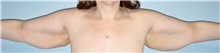 Arm Lift Before Photo by Keyian Paydar, MD, FACS; Newport Beach, CA - Case 51206