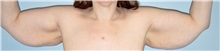Arm Lift Before Photo by Keyian Paydar, MD, FACS; Newport Beach, CA - Case 51206