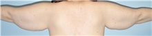 Arm Lift Before Photo by Keyian Paydar, MD, FACS; Newport Beach, CA - Case 51206